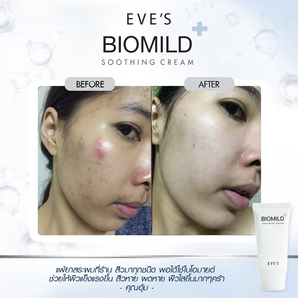 EVES อีฟส์ ไบโอมายด์ครีม BIOMILD SOOTHING CREAM ฟื้นฟูผิว ลดสิว ผดผื่น ลดการระคายเคือง แพ้แสบและคัน