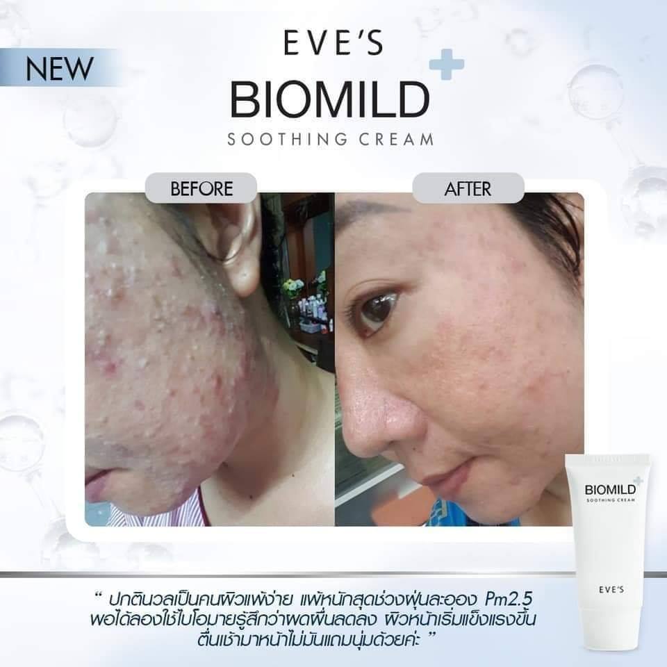 EVES อีฟส์ ไบโอมายด์ครีม BIOMILD SOOTHING CREAM ฟื้นฟูผิว ลดสิว ผดผื่น ลดการระคายเคือง แพ้แสบและคัน